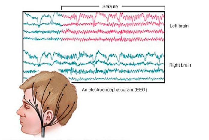 Campos electromagnéticos produzem alterações no Electroencefalograma